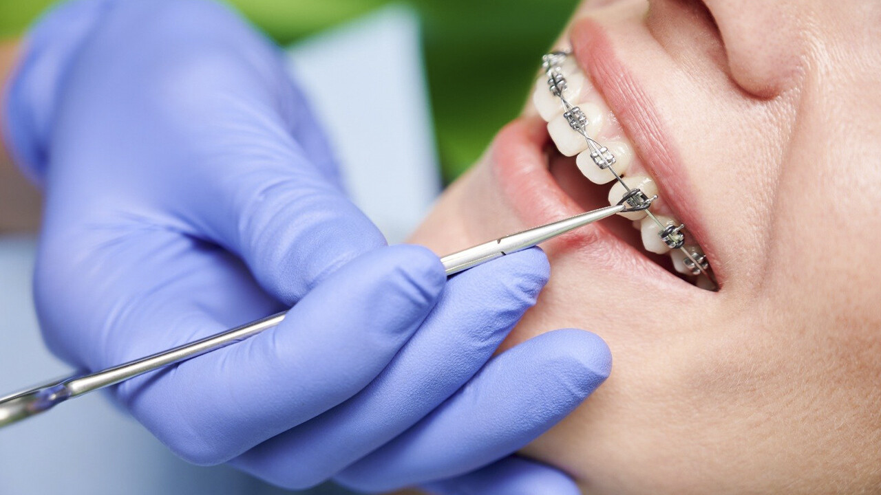 Cementación de Brackets: Claves para una Sonrisa Perfecta